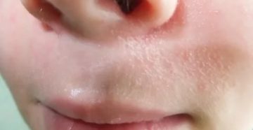 Мелкие прыщики на носу у ребенка Мелкие прыщики на носу у ребенка