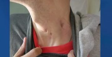Туберкулез периферических лимфатических узлов