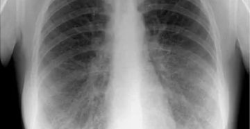 Как проверить легкие кроме флюорографии