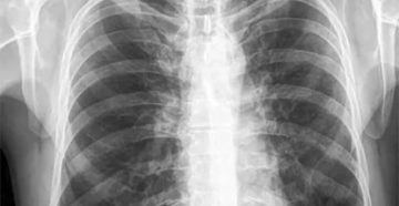 Посттуберкулезные изменения легких что это