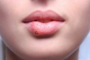 Сколько дней заразен герпес на губах