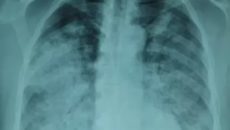 Рентгеновский снимок легких при пневмонии
