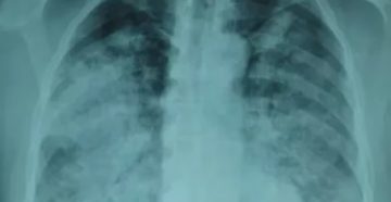 Рентгеновский снимок легких при пневмонии