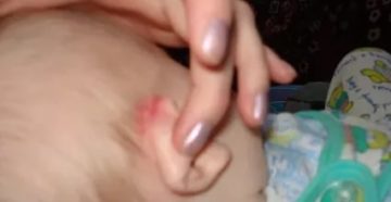 У ребенка мокнет за ушком что делать У ребенка мокнет за ушком что делать