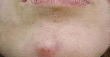 Уплотнение на подбородке под кожей