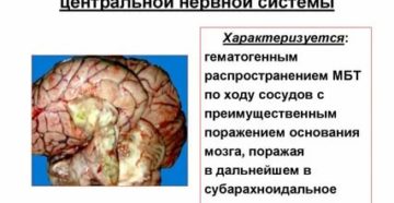 Туберкулез мозговых оболочек и цнс