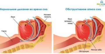 Западает язык во сне причины