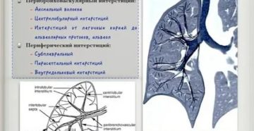 Интерстициальные изменения в легких что это