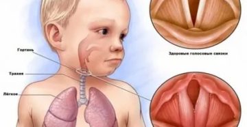 Можно ли гулять при ларинготрахеите