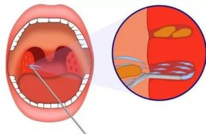 Как закалить горло при хроническом тонзиллите