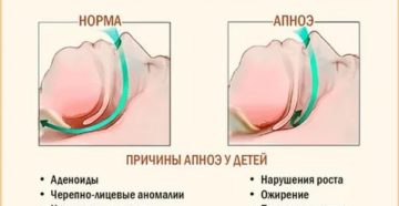 Кратковременная остановка дыхания у детей