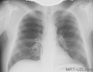 Рентген лёгких при пневмонии