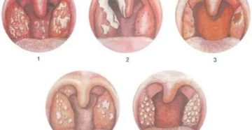 Грибковый фарингит фото