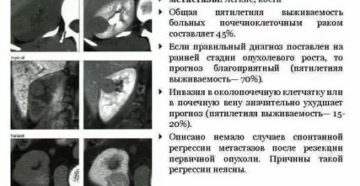 Рак почки метастазы в легкие сколько живут