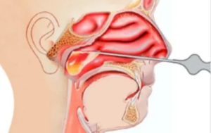 После прокола гайморовых пазух заложенность носа