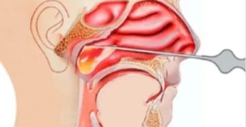 После прокола гайморовых пазух заложенность носа