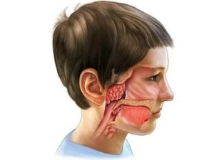Аллергический аденоидит у детей симптомы