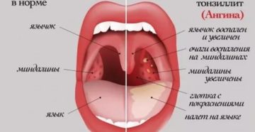 Красные миндалины у ребенка чем лечить