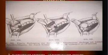 Ороантральное сообщение