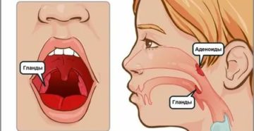Аденоиды и бассейн комаровский