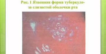 Туберкулез слизистой рта фото