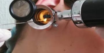 Прокол барабанной перепонки при отите