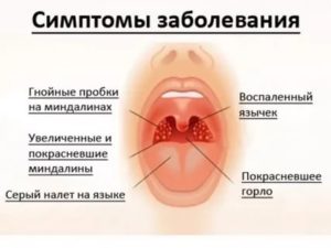 Первые признаки ангины как лечить