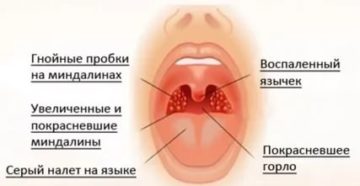 Первые признаки ангины как лечить