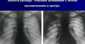 Туберкулез распад легких