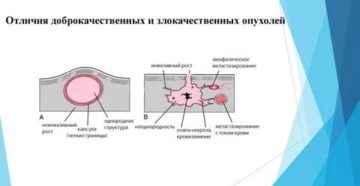 Доброкачественная опухоль это рак или нет