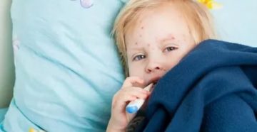 Кашель при ветрянке у ребенка Кашель при ветрянке у ребенка