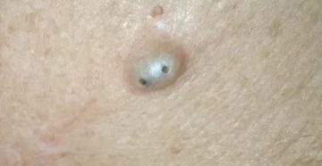 Может ли атерома рассосаться сама