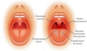 Что значит рыхлое горло у ребенка