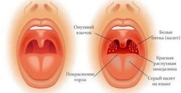 Что значит рыхлое горло у ребенка