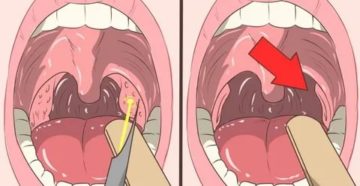 Коблационная тонзиллэктомия