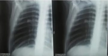 Туберкулёма лёгких заразна или нет