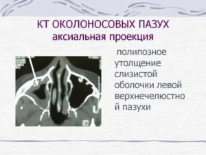 Гипертрофия слизистой гайморовой пазухи