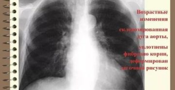 Уплотнение корней легких как лечить