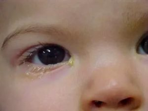 У ребенка из глаза течет желтая жидкость