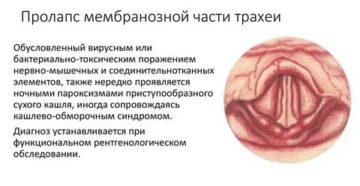 Пролапс трахеи