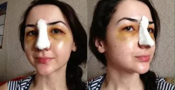 Сколько заживает нос после ринопластики