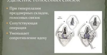Удаление голосовых связок